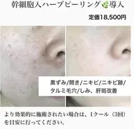 ミニモ学割【憧れの韓国肌♪】最安値/毛穴洗浄＋天然ハーブピーリング🌿剥離無、赤み・ニキビ・ごわつき