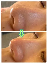 初めてのご来店の方、ぜひお試しください❣️毛穴洗浄でつるつるな触り心地＆透明感アップ⤴️鼻やアゴもなめらか美肌✨