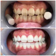 【初回ご新規様限定】ハイパワーコース​〜​超集中照射​〜​　15分×3照射