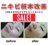 肌質根本改善❤ハーブピーリング