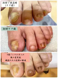 【モニター特別クーポン】◆爪トラブル(中〜重度)◆陥入/肥厚/巻き爪【トラブルケア】