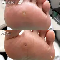 【魚の目ケア】朗報✨【🉐2回目以降もずっと"施術料が500円🉐】足裏ゴワゴワ痛〜い魚の目をキレイな足裏へ💁♀️