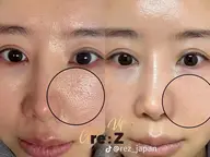 美肌！韓国肌質改善🇰🇷まずはお試しプラン✨ニキビ跡/毛穴/くすみ/たるみ🌿