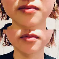 【期間限定ご褒美メニュー】目指せ小顔‼️フェイシャルエステ初回施術の方（お顔引き締め・リフトアップ&トラネキサム酸導入）