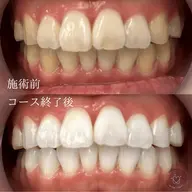 ※初回はジェルの注文のみです！【持続期間・白さにこだわるなら】歯科提携ジェルホワイトニング　美容ホワイトニングは当日可能