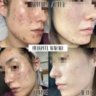 【諦めないで‼️もう繰り返さない最強ニキビケア🌿✨】REVI 🌹ハーブピーリング🌿ニキビ撲滅‼️集中改善コース🌿