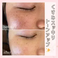 【シンプルエイジングケアコース】老廃物を流してスッキリ小顔に🤍気になる乾燥シワたるみに効果的!