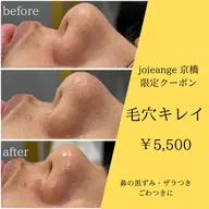 【ミニモ限定】鼻/顎/眉間の角栓,黒ずみ除去【溶ける角栓毛穴吸引&洗浄】¥5,980→¥4,980