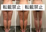 【術後ケア】脂肪吸引後のダウンタイムに💫拘縮・浮腫み・だるさ・引き攣れ