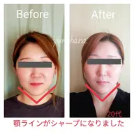 《🌟条件付🌟》人気No.1小顔／小顔リフトアップコース(60分)モニター募集