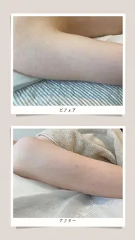 ひじ下（手指含/両腕） ※自己処理なしでお越しください.