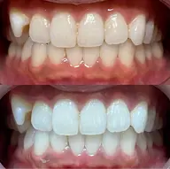 セルフホワイトニング🦷8分×2回照射(空きはリクエストからお問い合わせください)