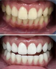 【初回限定⭐︎特別価格】超集中ハイパワーコース◎しっかり結果をだしたい方！（15分照射×2）