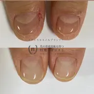 【手荒れ・噛み癖》お悩み解消!爪育成