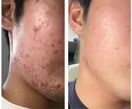 【学生限定モニター価格】1ヶ月に2回ご来店可能な方のみ‼️痛くないハーブピーリング🌿¥13,200→¥9,240/回