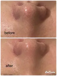 毛穴ピーリングでつるんと小鼻美人✨