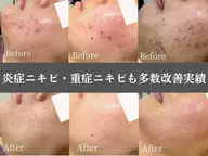 【まずは】一時的でないニキビ根本改善◎ニキビ専門サロン・お肌無料相談