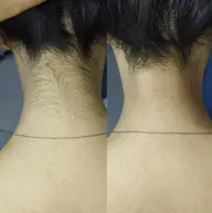 全身脱毛丸投げお試し価格！最新LEDマシーン！！！IPL脱毛は、時代遅れ！フェイシャルパック付き！