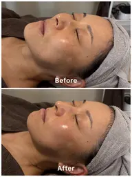 💎リジュラン(PDRN)✖️4Dリカバリーフェイシャル💎骨格・神経・筋肉・皮膚へアプローチ(施術時間約60分)