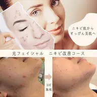 【光フェフィシャル】二キビ肌・トラブル肌大歓迎✨どんなお肌の方もすっぴんに自信がつく肌へ