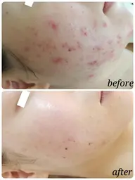 \ニキビ・毛穴に特化/!!次世代ハーブピーリング!!剥離もなくてつづけやすい!
