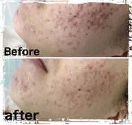 🔶美顔🔶【肌質段違い◎ツルスベむき卵肌】豪華セット♪イオン水ピーリング+毛穴洗浄☆お悩み肌 ニキビ対策！