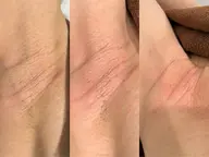 【レディース全身フルケア】顔・Vio込！最新マシンで最短卒業