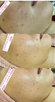 【❣️ミニモ特別価格❣️】長年の肌荒れでも諦めないで❗️肌荒れ・素早く改善&リフレッシュ60​〜​70分