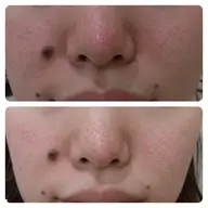 【毛穴の詰まり・黒ずみ・角栓へアプローチ◎】毛穴洗浄コース/肌診断+パックor超音波+リフトアップ+栄養 90分