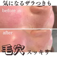 気になる毛穴へ！超音波毛穴洗浄エステ