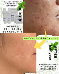 【お昼限定】肌荒れ！サンゴハーブピーリング🌿&高周波フェイシャルエステコース初回体験