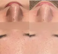 NEW🌟育てて守る《肌育コラーゲン導入》付毛穴洗浄ハイドロfacial🫧