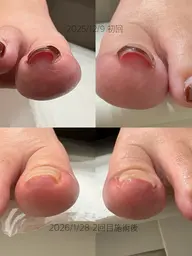 巻き爪解放プレート装着親指２本