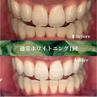 【人気No.1コスパ最強◎自然な白さへ】セルフホワイトニング30分照射　初回体験