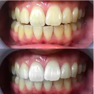 【本気で白くしたい方に‼️8分照射×4回】ノーマルセルフホワイトニングで継続ケア🦷