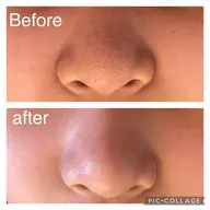 いちご鼻スッキリ❣️毛穴角栓コース❣️