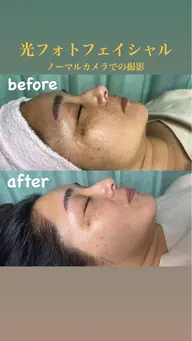 (新規)肌再生‼️シミ、そばかす、ハリ、艶、リフトアップしたい方‼️ 最新光フォトエステ💆‍♀️💡💡パック付き