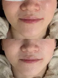 レディースフェイシャル脱毛