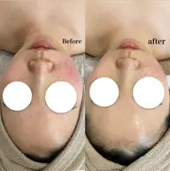 韓国式ピーリング