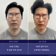 スーパージェクション韓国式肌管理