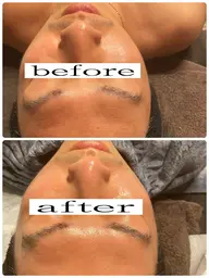 REVI次世代ハーブピーリング!陶器トリートメント♫陶器パウダー2g配合+リバイバルセラム配合♫