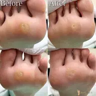 【足裏タコケア】足裏にできたゴワゴワ🌀角質もスベスベの足裏に✨是非お試しください💁♀️