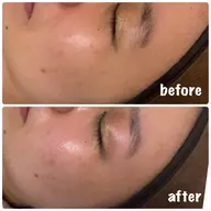 メイクノリ抜群🪞おでかけ前の特別ケア☀️💭垢抜け肌管理✅毛穴洗浄+フェイシャルワックス+ビタミンC導入【口コミ価格】