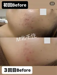 【剥離あり】ハーブ2倍量で効果アップ!!広範囲のご症状の方に!!20000円