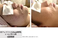 ニキビ集中ケア！プラズマ光フェイシャル【思春期ニキビにも◎】　メンズもOK！