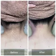 【✨️うなじ+背中セット脱毛✨️】女性限定🎀夏に向けて後ろ姿まで美人へ✨️