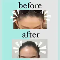 顔脱毛（眉間、眉上、もみあげ当てられます）