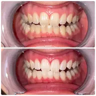 【平日18時迄】🎈口コミ限定クーポン🎈15分×2回照射 8800円→1100円🧡