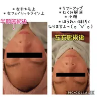 顔ツボフェイシャル🍀痛気持ちいい感じでの施術✨