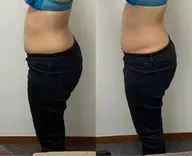 痩身機械が進化しました✨トリプル攻撃🤛キャビテーション&ラジオ波&吸引　部位：【お腹】